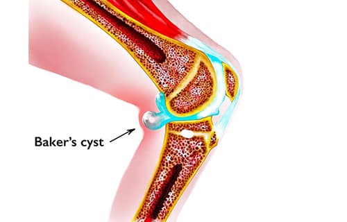baker cyst